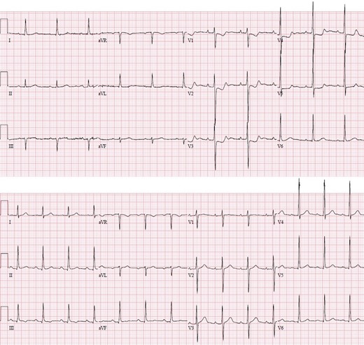 Electrocardiogram with chest pain (top) demonstrating new ST-depression concerning for myocardial ischemia significantly different than baseline ECG on admission (lower).