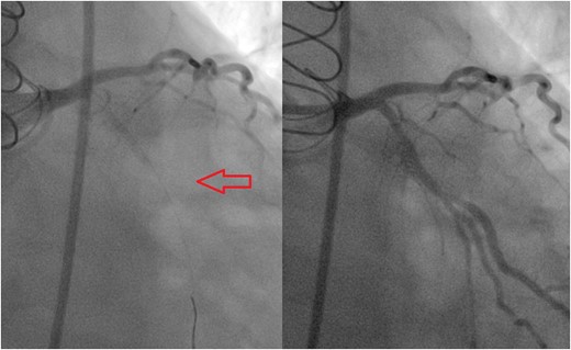 Angiogram before (left) and after (right) aspiration thrombectomy demonstrating excellent angiographic result.