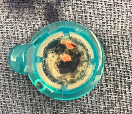 Aspirate from thrombectomy catheter.