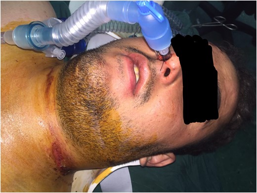 A 25-year-old man with blunt neck trauma (after intubation).