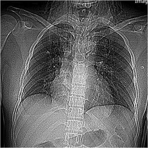 Supin chest radiograph showing pneumomediastinum and neck subcutaneous emphysema.