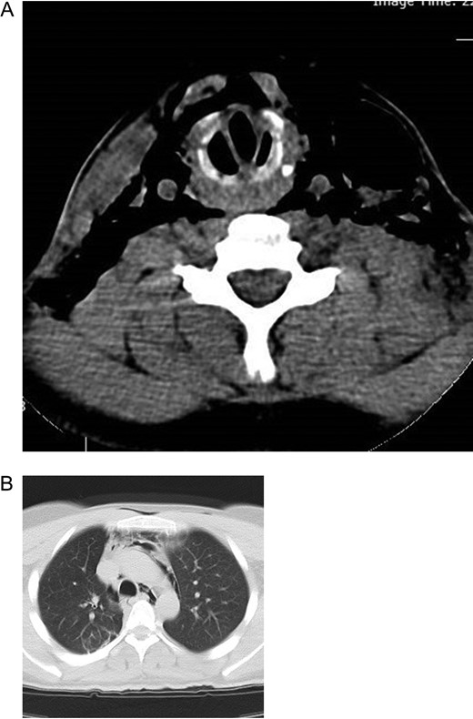 (A) CT image of the neck showing subcutaneous emphysema and larygotracheal framework distortion. (B) CT image of the chest showing pneumomediastinum.