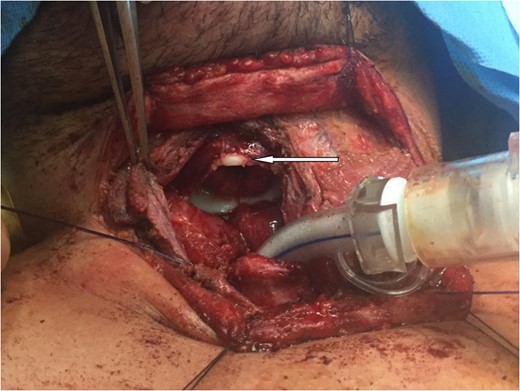 Neck exploration demonstrated complete cricotracheal separation (arrow showing cricoid).