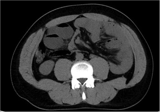 Axial CT abdomen and pelvis revealing internal hernia with evidence of small bowel obstruction.