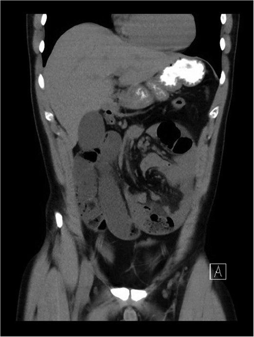 Coronal view of CT abdomen and pelvis revealing incarcerated internal hernia with signs of small bowel obstruction, whirl sign suggestive of volvulus.