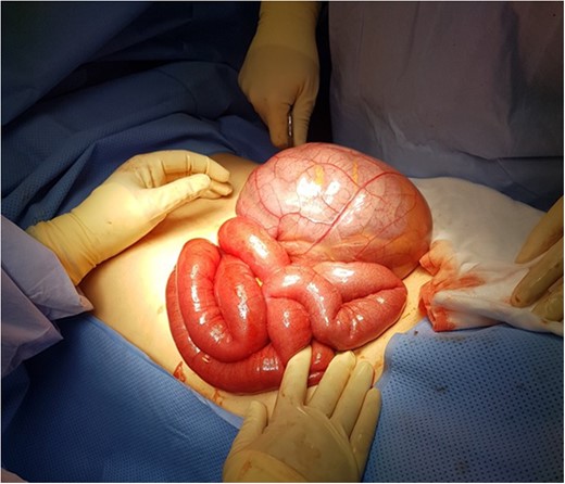 Intra-operative picture post exteriorizing of defect and obstructed small bowel, showing the transmesenteric hernia, covered with thin mesenteric membrane prior to reduction of incarcerated small bowel.