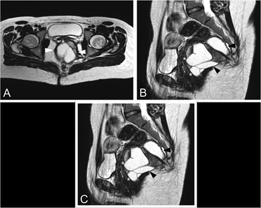 Preoperative MRI. (A) Axial TSE T2-weighted images show a large multiloculated cystic lesion (arrowhead) dislocating and closely adherent to the posterior rectal wall (*). (B) This sagittal TSE T2-weighted image shows a cystic lesion (arrowhead) expanded in the posterior pararectal space, containing serum-proteinaceous material, following the course of the rectal distal portion (*) in the context of the levator ani muscle. (C) Coronal TSE T2-weighted images demostrate the relations among the cystic lesion (black*), the rectum (white*) and the levator ani muscle (arrowhead).