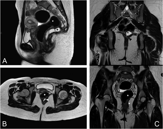 Eight months follow-up MRI. (A) This sagittal TSE T2-weighted image shows a recurrent cystic lesion (+) expanded in the posterior pararectal space, containing serum-proteinaceous material, following the course of the rectal distal portion (*) in the context of the levator ani muscle. (B) Axial TSE T2-weighted images show the cystic lesion (arrowhead) closely adhering to the posterior rectal wall. (C) Coronal TSE T2-weighted images demostrate the relations among the cystic lesion (black*), the rectum (white*) and the levator ani muscle (arrowhead).