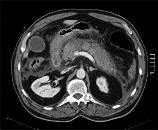 Signs of acute edematous pancreatitis.