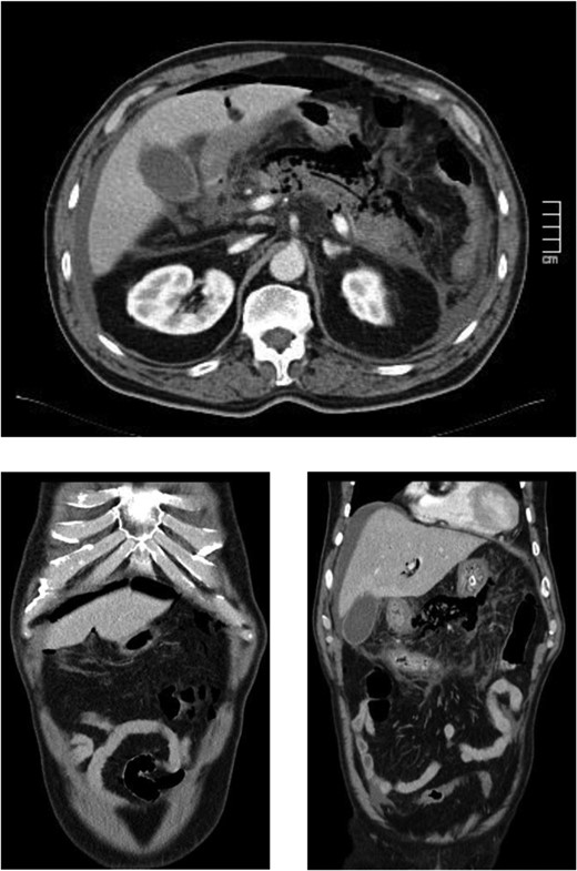 (After 16 h) Signs of necrotizing pancreatitis with pneumoperitoneum and pneumoretroperitoneum, pneumobilia and air on the main pancreatic duct.