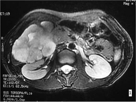 MRI imaging. In the right hepatic lobe a lesion of 9.6 × 8.9 × 7.9 cm3 is observed, hyperdense in T2W presenting contrast enhancement.