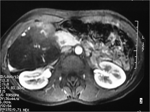 MRI imaging. Involvement of hepatic segments VI and VII.
