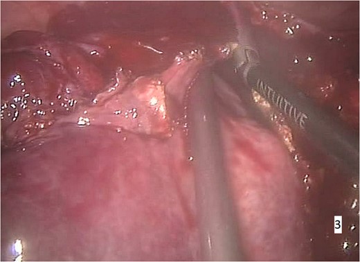 Intraoperative imaging. Segmental right hepatectomy and removal of the excised specimen through a small abdominal incision.