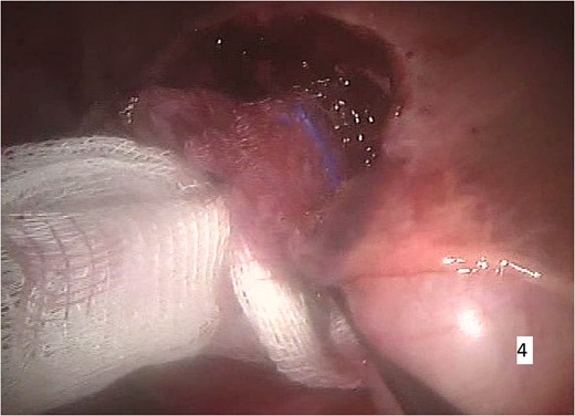 Intraoperative imaging. Minimal intraoperative blood loss.