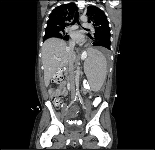 Computed tomography of the abdomen showing hepatosplenomegaly with free fluid around te spleen.