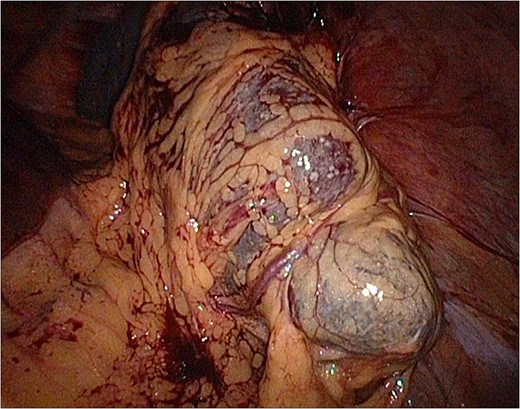 Laparoscopy: spleen covered with omentum.