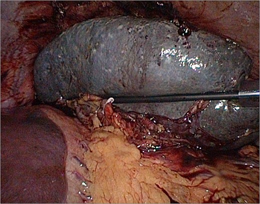 Laparoscopy: spleen after dissection and clipping of the splenic artery.