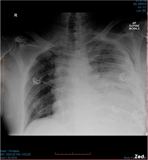 Initial chest x-ray was suspicious for left-sided haemopneumothorax.