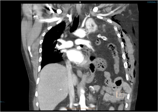 Coronal CT slide showing the entire left haemithorax being replaced by abdominal contents. Note the subcutaneous emphysema post ICCT insertion.