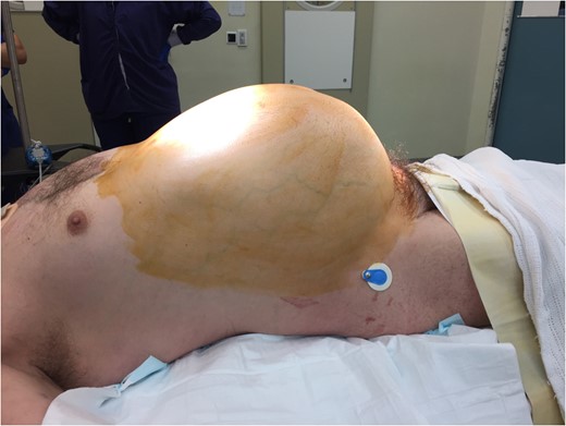 Pre-operative picture showing tension pneumoperitoneum with a very distended abdomen.