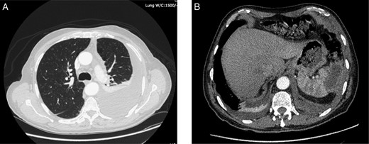 CT scan taken on admission showing. (A) left-sided pleural effusion with empyema and septal loculations and (B) a subcapsular splenic abscess of approximately 5 cm × 2 cm × 3 cm with an approximate volume of 14 cc.