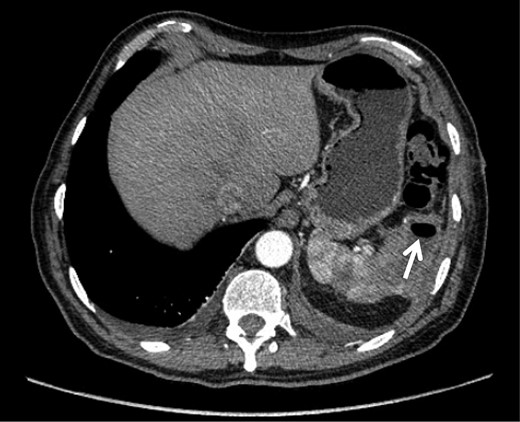 CT scan taken 5 days after admission demonstrating an increase in the size of the splenic abscess as well as the presence of gas within its walls (arrow).
