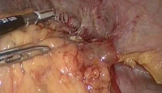 Splenic mass, inflammatory adherences from the major momentum to the spleen, colon and diaphragm.