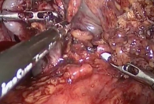 Inflammatory tissue dissection and drainage of the splenic abscess.