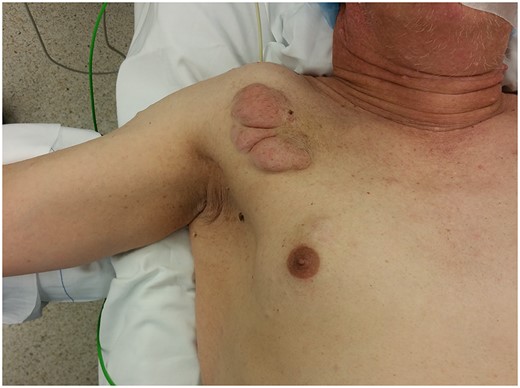 Right chest wall neurofibroma. Breast cancer is superior to the nipple.