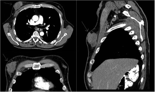 Preoperative staging CT scan. Chest wall mass noted to be 6.9 cm × 2 cm.