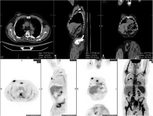 Post chemotherapy PET/CT scan. The breast mass decreased in size, with no mediastinal or hilar lymphadenopathy.