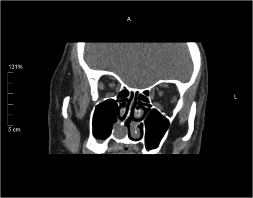 Coronal unenhanced CT sinus showing a 15 mm rounded soft tissue lesion arising from the right inferior turbinate thinning the medial wall of the right maxillary antrum and slightly bulging in to the sinus.