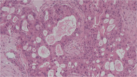 Cellular stroma extensively infiltrated by carcinoma composed of large eosinophilic cells with gland formation on medium power view. Haemotoxylin and eosin (H&E).