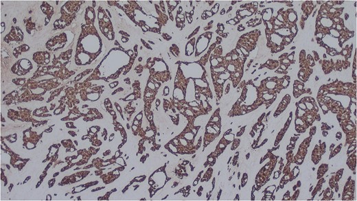 Salivary duct carcinoma cells highlighted by immunohistochemistry. CK7 (x25).