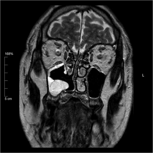 Coronal T2 image showing post-operative changes. No evidence of residual tumour.