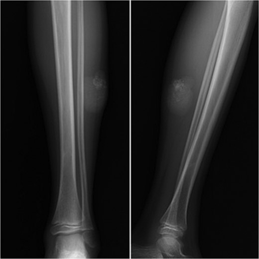 Image of calcification on the posterolateral part of the cruris.