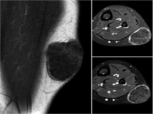 Magnetic resonance image of the homogeneous lesion, visualized with regular margins and including patch-like areas.