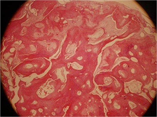 Lesion showing development in the form of irregular islands made up of a nucleate eosinophilic shadow cells, with the spindle-like fibroblastic cells between them.