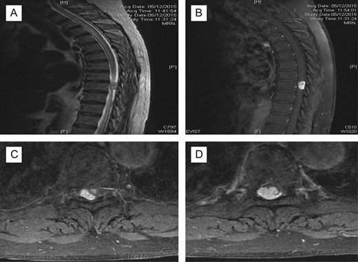 Pre-op MRI scan. Enhancing intraspinal lesion, most likely extramedullary intradural in location, at the level of T9 causing spinal cord compression associated with extensive cord oedema; (A) T2 sagittal; (B) with contrast, sagittal; (C, D) axial with contrast at T9 level; suggestive of intradural extramedullary (C) extending intramedullary (D).