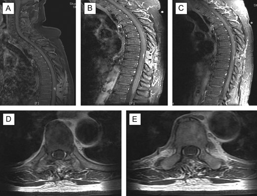 Post-operative follow-up MRI scan. There is residual focus of dural thickening and enhancement at the level T9 which demonstrated further reduction in prominence (A–C); there is resolution of the cord oedema and no new enhancing lesion is seen in the spinal canal; (A) sagittal with contrast 3 months’ follow-up; (B) 6 months’ follow-up; (C) 11 months’ follow-up; (D + E) axial views with contrast 11 months’ follow-up at T9 level.