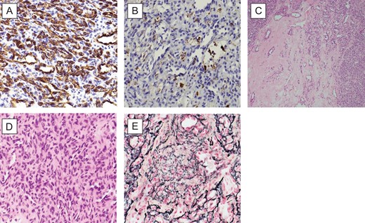 (A) (CD34X40): patchy CD34 immunoreactivity in tumour cells and endothelial cells; (B) (FXIIIAX40): focal FXIIIa positivity in tumour cells; (C) (HEX10): highly vascular spindle cell tumour with numerous slit like and staghorn vascular spaces, featuring hypocellular and cellular areas; (D) (HEX40): closely packed randomly oriented bland spindle cells; and (E) (RETICULINX40): well-developed network of reticulin fibres surrounding individual cells.