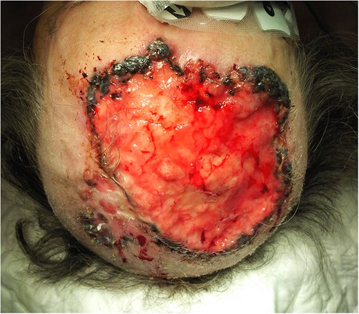 Extensive BCC involving the scalp and the forehead, preoperative finding.
