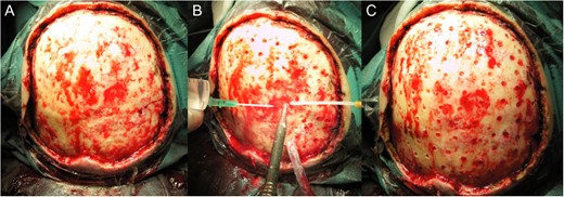 Intraoperative view of the resection defect. (A) without periostium, (B) and (C) during and after drilling.
