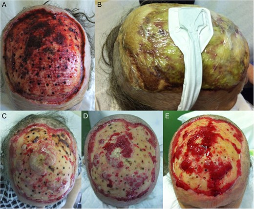 (A) One week after surgery, with classic dressing with necrosis and no proliferation of tissue. (B) Starting of negative pressure wound therapy at that time. (C) One week after, (D) 2 weeks after and (E) 3 weeks after.