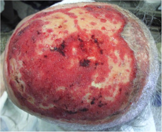 Four weeks after NPWT and 5 weeks after initial surgery.