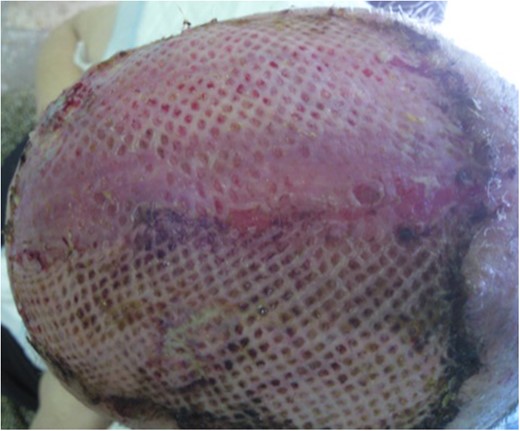 SSG and 6 weeks after initial surgery.