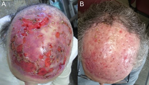 (A) One month after SSG and (B) 6 months after SSG.