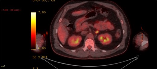 PET scan demonstrating a left adrenal lesion with high metabolic activity.