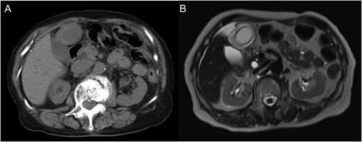 (A) Unenhanced computed tomography image. A gourd-shaped gallbladder with biphasic appearance was revealed. In the fundus side, the wall of the gallbladder appears oedematous and thickened, while the neck side appears intact. (B) T2-weighted magnetic resonance image.