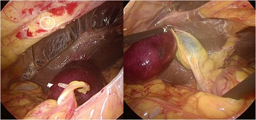 Intraoperative laparoscopic finding. A tip of the omentum encircling the gallbladder adhered to the abdominal wall and strangled the gallbladder. By cutting the attachment site of the omentum, the strangulation was released and a whole image of gallbladder appeared. The gallbladder was found to have been strangulated by the band between the omentum and abdominal wall. A circle shows the attachment site of the omentum at the abdomen. The arrow shows the tips of the omentum, which encircled and strangled the gallbladder.